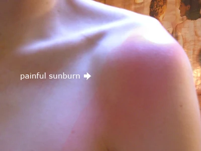 Josh is burnt by the sun.